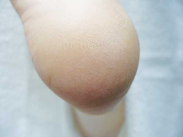 Cracked Heel Formula