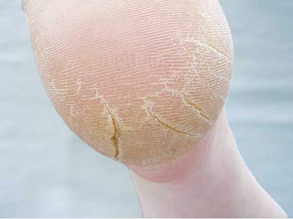 Cracked Heel Formula